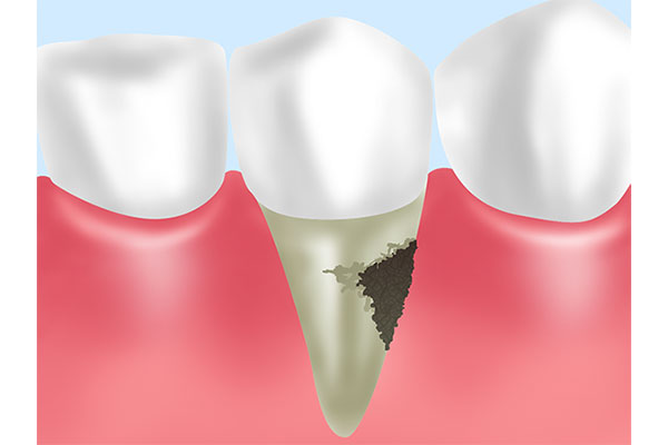 4.重度歯周炎