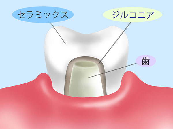 フルジルコニアセラミック