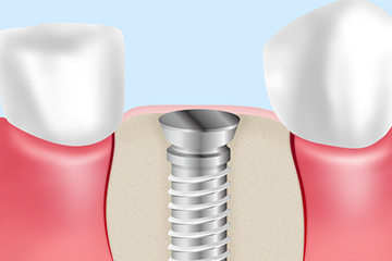 3、インプラント埋入～歯冠取り付け