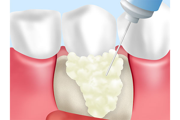 歯周組織再生療法