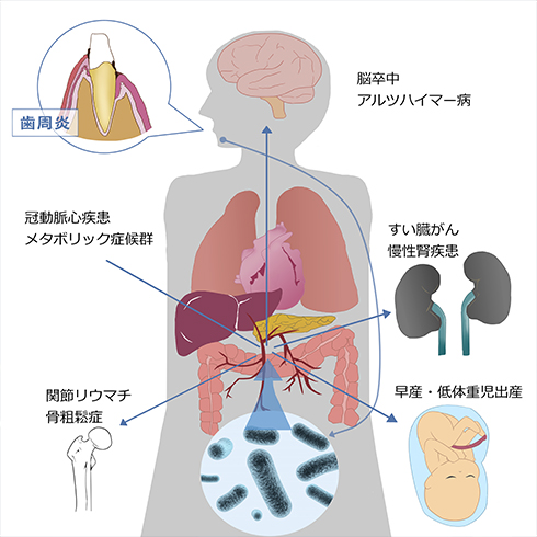 全身に悪影響を及ぼす歯周病対策はプラークコントロールが重要