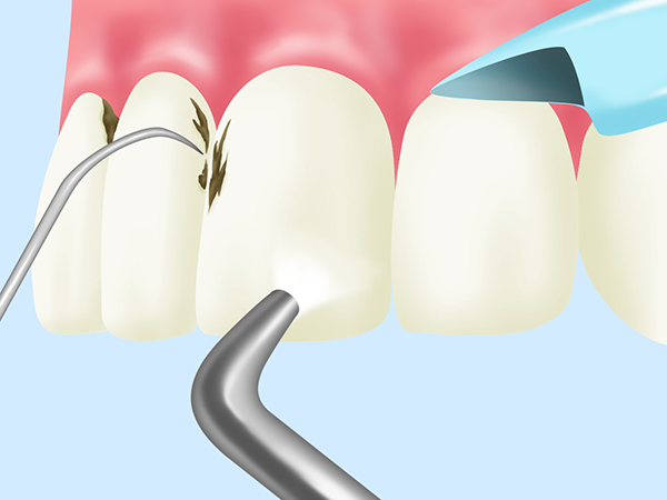 歯石除去