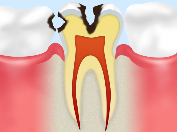 C2（象牙質に達した虫歯）