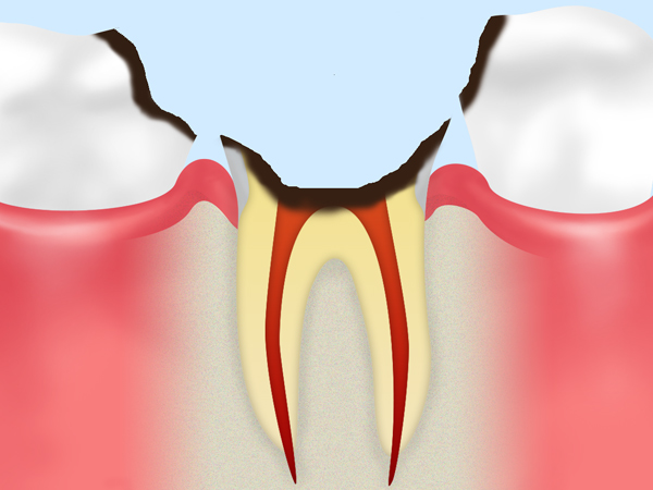 C4（歯根に達した虫歯）